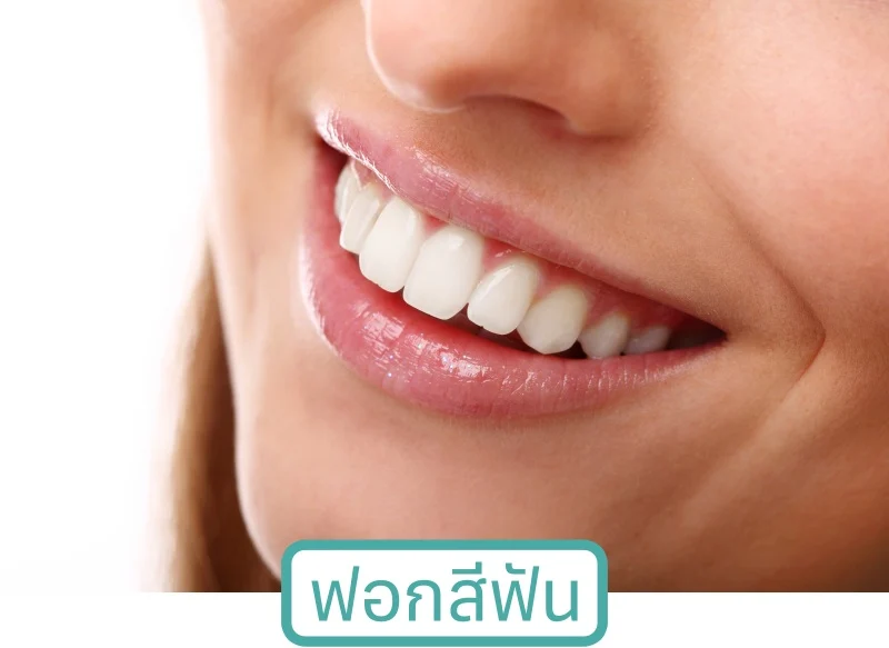 ฟอกสีฟัน ที่ Dio Dental ฟันขาวทันใจ สว่างใสทันตา 